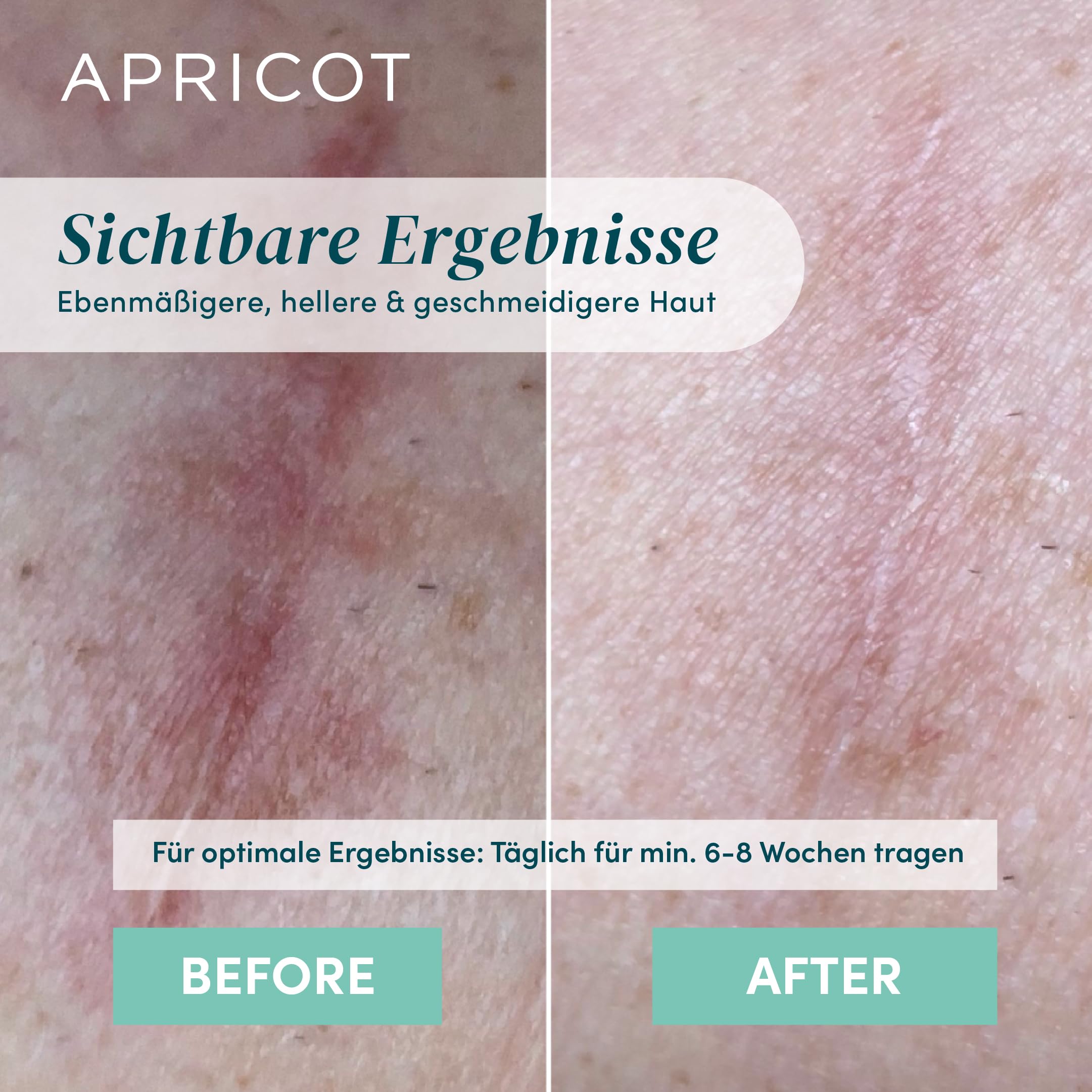 APRICOT 2x Silikon Narben Pad mit Bio-Aloe Vera aus medizinischem 16,5cm x 3,5cm - 30x Wiederverwendbar - Silikonpflaster für Narben, Narbenpflaster Silikon, Kaiserschnitt Narbenpflege OP