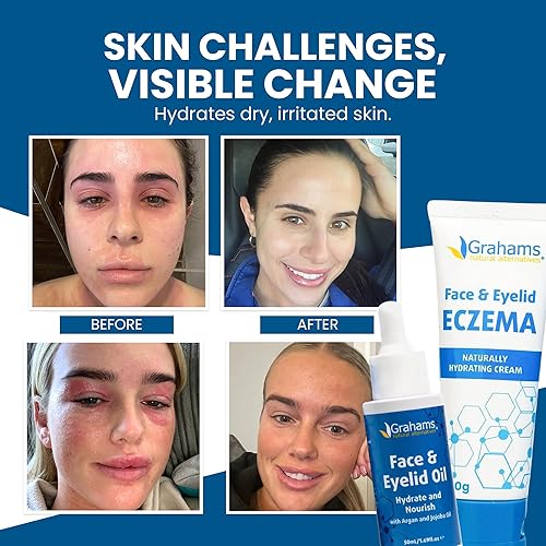 Miniatura 2 de Grahams Natural Kit de alivio del eccema facial y de párpados, tratamiento para piel seca, eczema, dermatitis pereriana y seborreica  Alivio de
