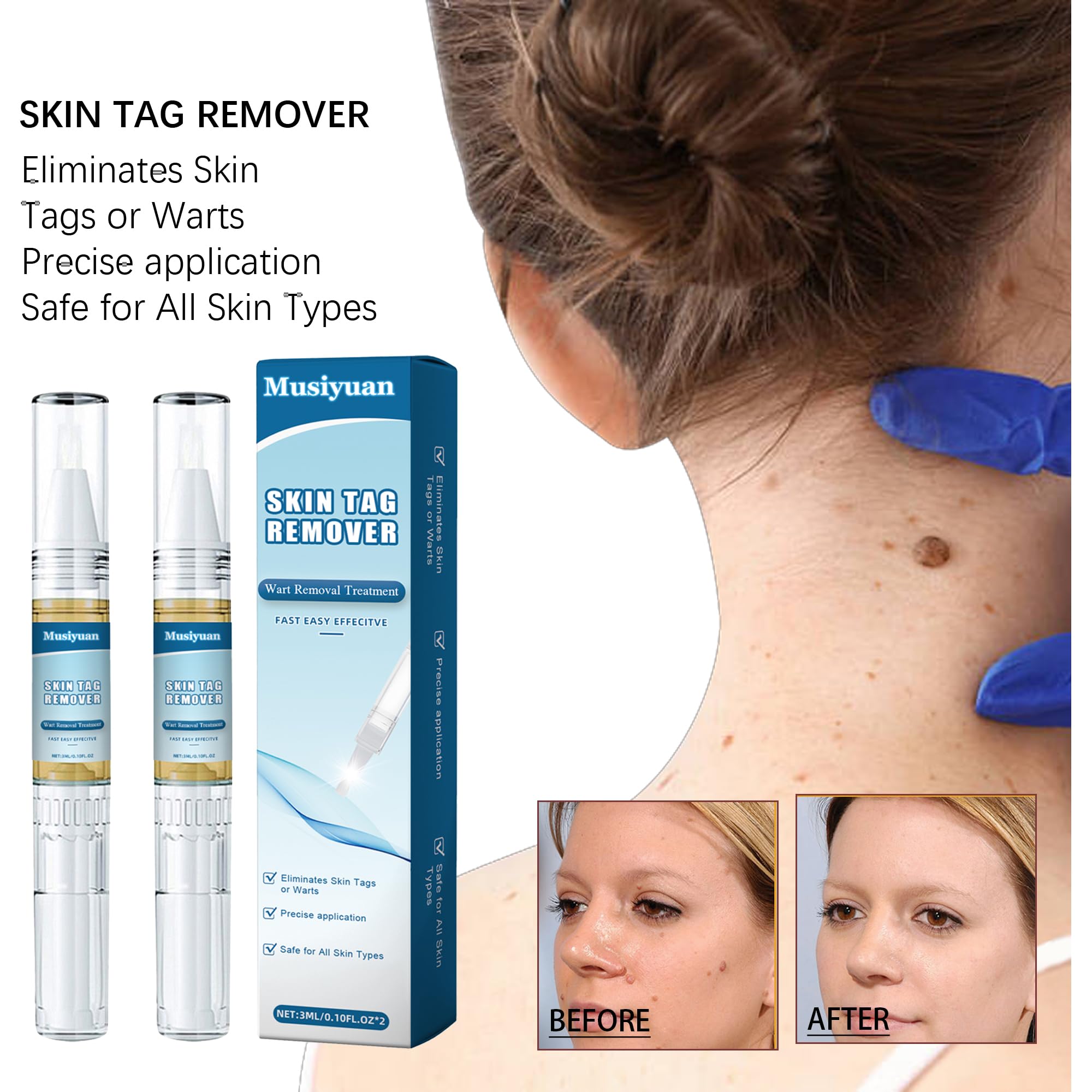 Lápiz removedor de verrugas, kit para eliminar verrugas en cuerpo y manos, apto para todo tipo de piel - Paquete de 2
