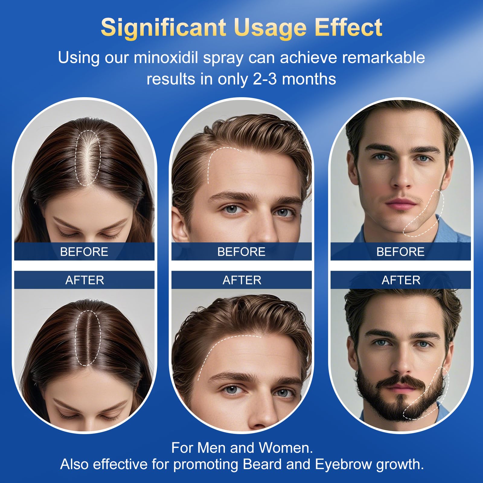 5% Minoxidil Hair & Beard Regrowth Spray with Biotin for Men & Women
