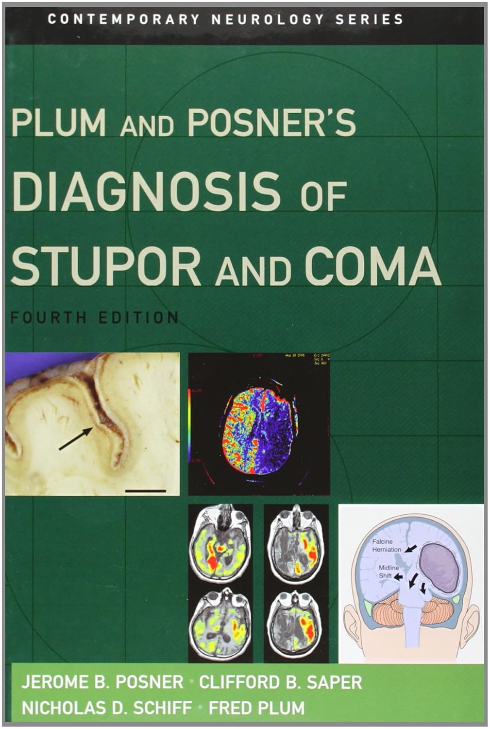 Plum and Posner's Diagnosis of Stupor and Coma