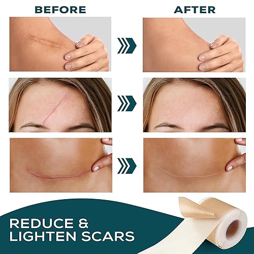 Miniatura 3 de Hojas de silicona para cicatrices  Cinta de cicatriz de silicona  Cinta de cicatriz para cicatrices quirúrgicas  Tiras de silicona para eliminación
