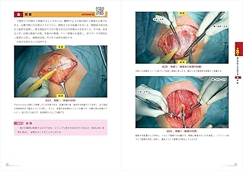 Amazon.co.jp: 改訂2版 腹式単純子宮全摘出術： 開腹から広汎