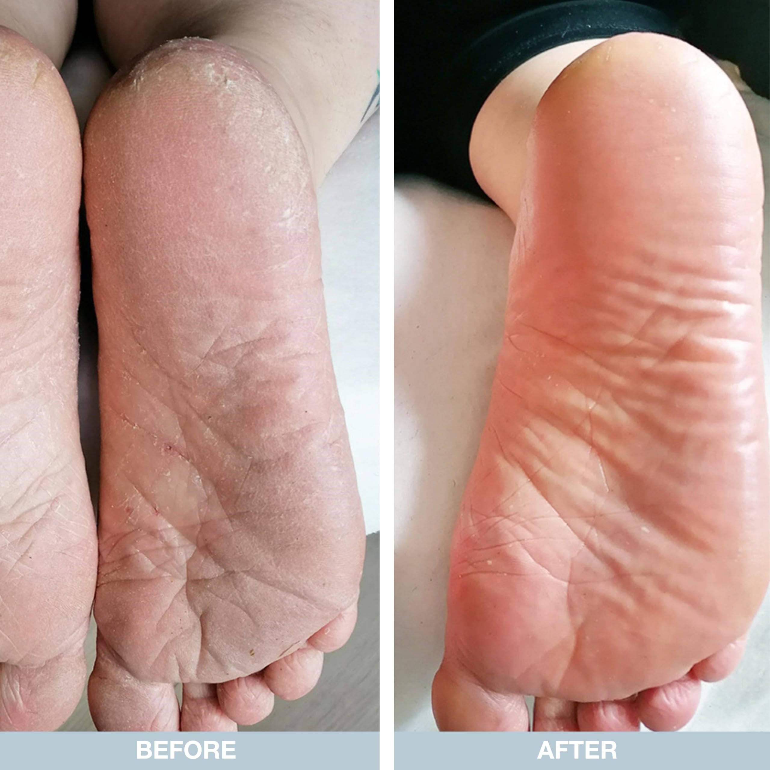 Creme per i piedi 500 ml | Ideale per rimuovere i duroni ed adatta per uomini e donne | Trattamento per piedi secchi e screpolati con 10% d’urea | Con olio dell’albero del tè australiano