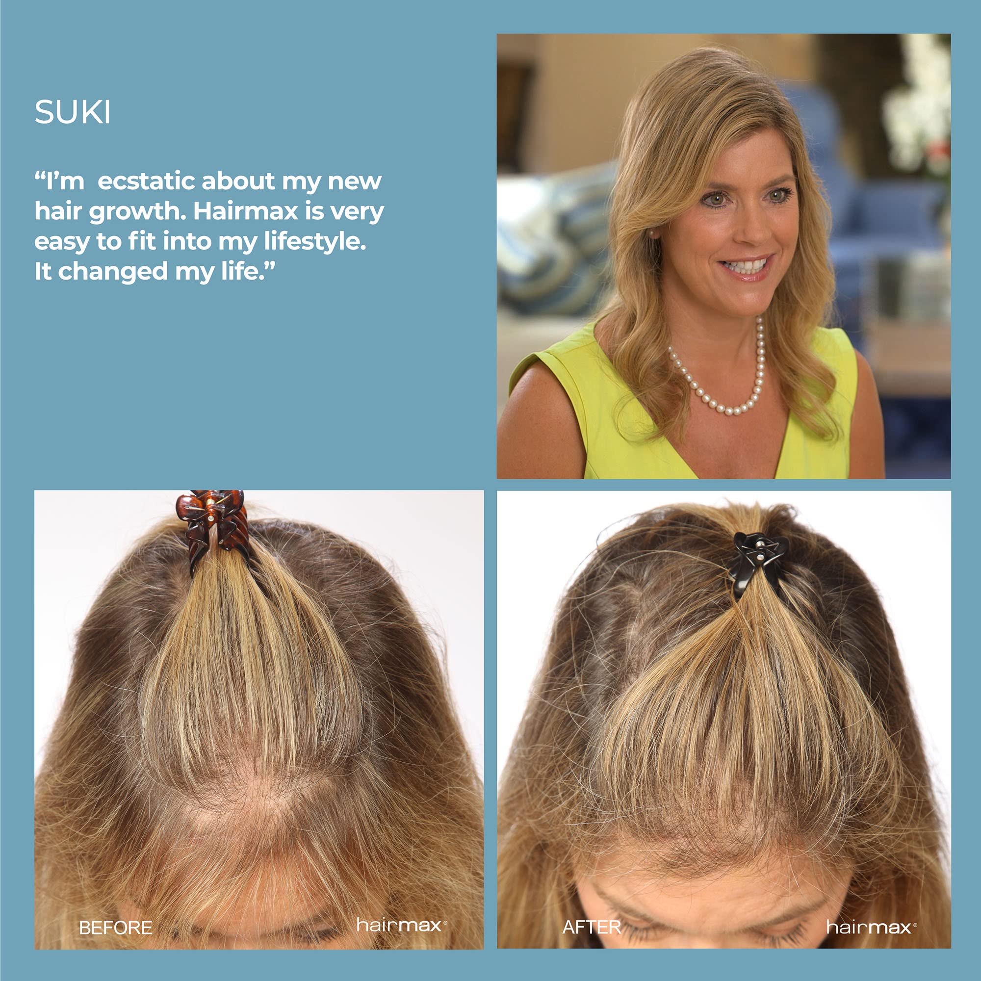 HairMax Laser Hair Growth Comb, FDA Cleared, Ultima 12, Laser Hair Growth Treatment for Men