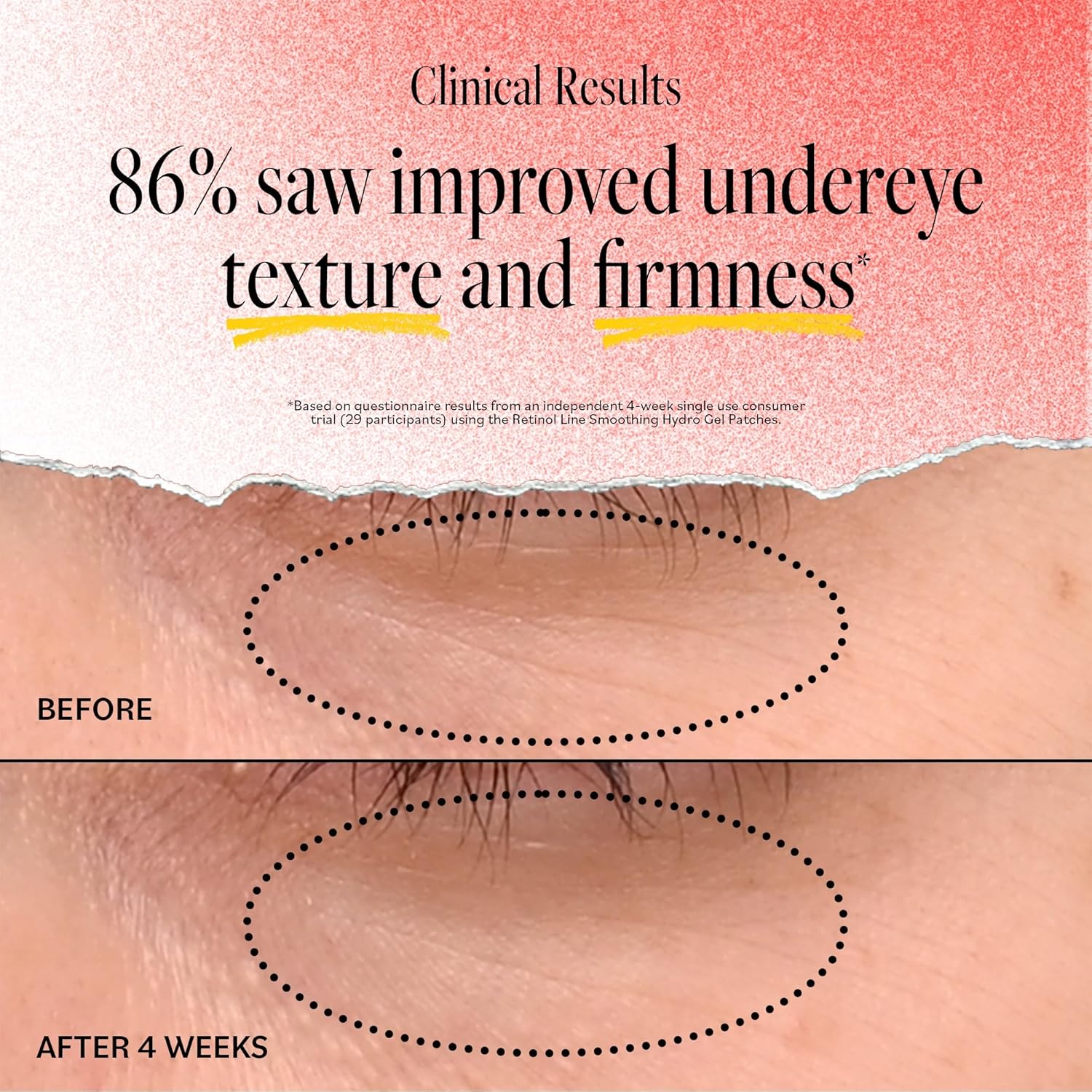 DERMA E Retinol + Bakuchiol Under Eye Patches (5 Pairs) Non-Irritating, Line Smoothing Hydro Gel Eye Patches with Rose Water & Real Hibiscus Petals, Helps Reduce Fine Lines, Crows Feet & Wrinkles,10Ct - Image 4