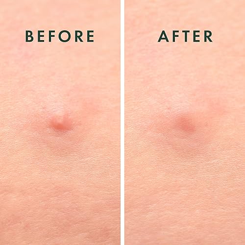 Miniatura 7 de Rael Miracle - Cubierta para manchas de microcristal, hidrocoloide, parches para manchas de acné con aceite de árbol de té, etapa temprana (36