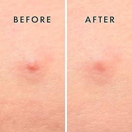 Rael Pimple Patches, Miracle Microcrystal Spot Cover - Hydrocolloid Acne Pimple Patch with Tea Tree Oil, Early Stage Zits and Blemish, Korean Skin Care (9 Count)