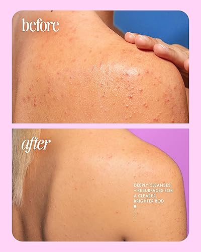 Miniatura 8 de Truly Beauty Cherry Jelly Gel de gel corporal para el acné con niacinamida de cereza, alantoína hidratante y ácido mandélico, galardonado para el