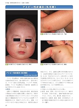 【中古】 小児のアトピー性皮膚炎/現代医療社/西間三馨 中古】 小児のアトピー性皮膚炎/現代医療社/西間三馨 中古】 小児