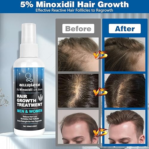 Miniatura 2 de 5% de mininoxidil para hombres y mujeres, 3.4 fl oz de minoxidil para el crecimiento del cabello, spray de tratamiento de regeneración del cabello,