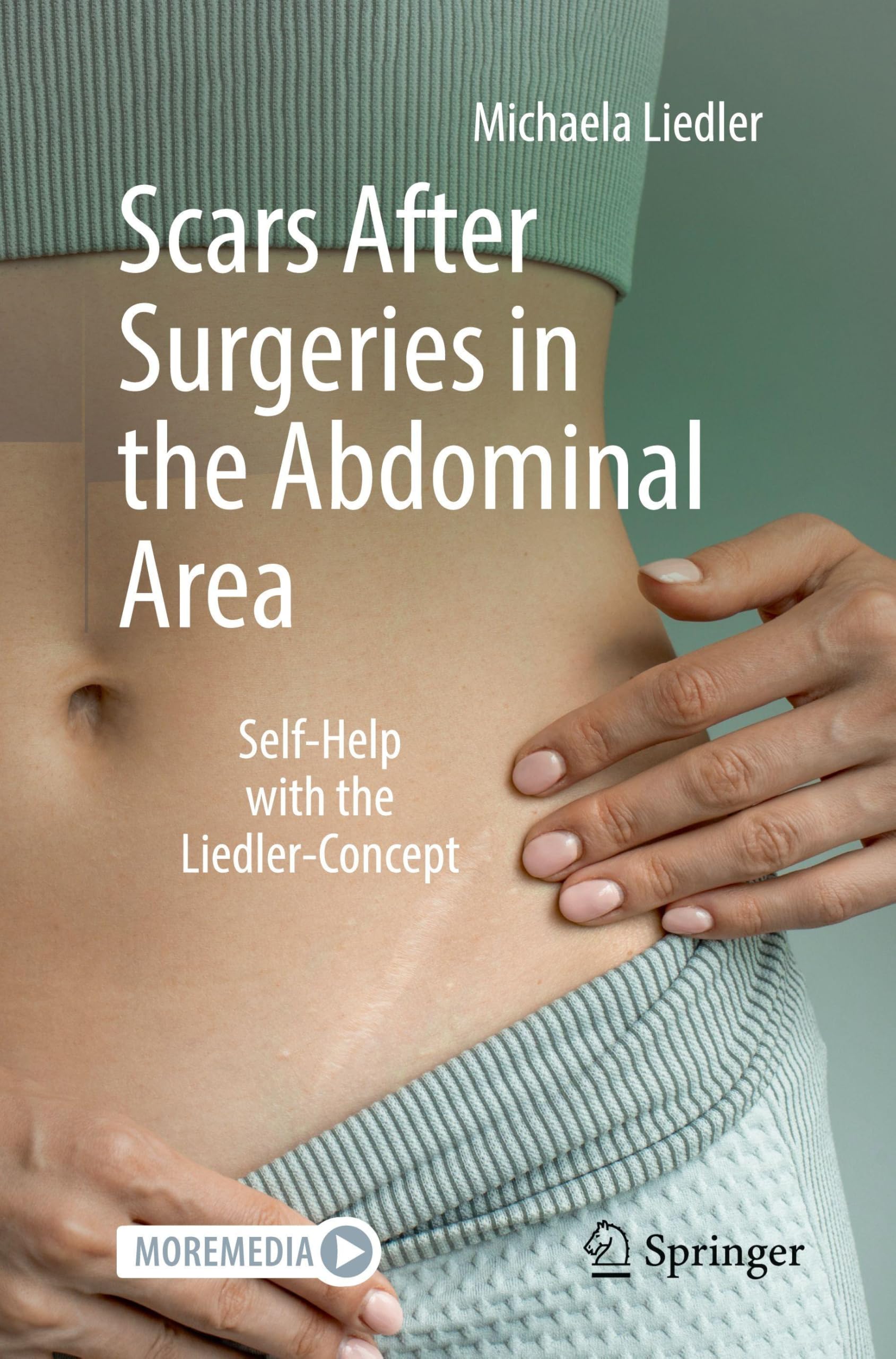 Scars After Surgeries in the Abdominal Area: Se. Liedler, Michaela-Michaela-**
