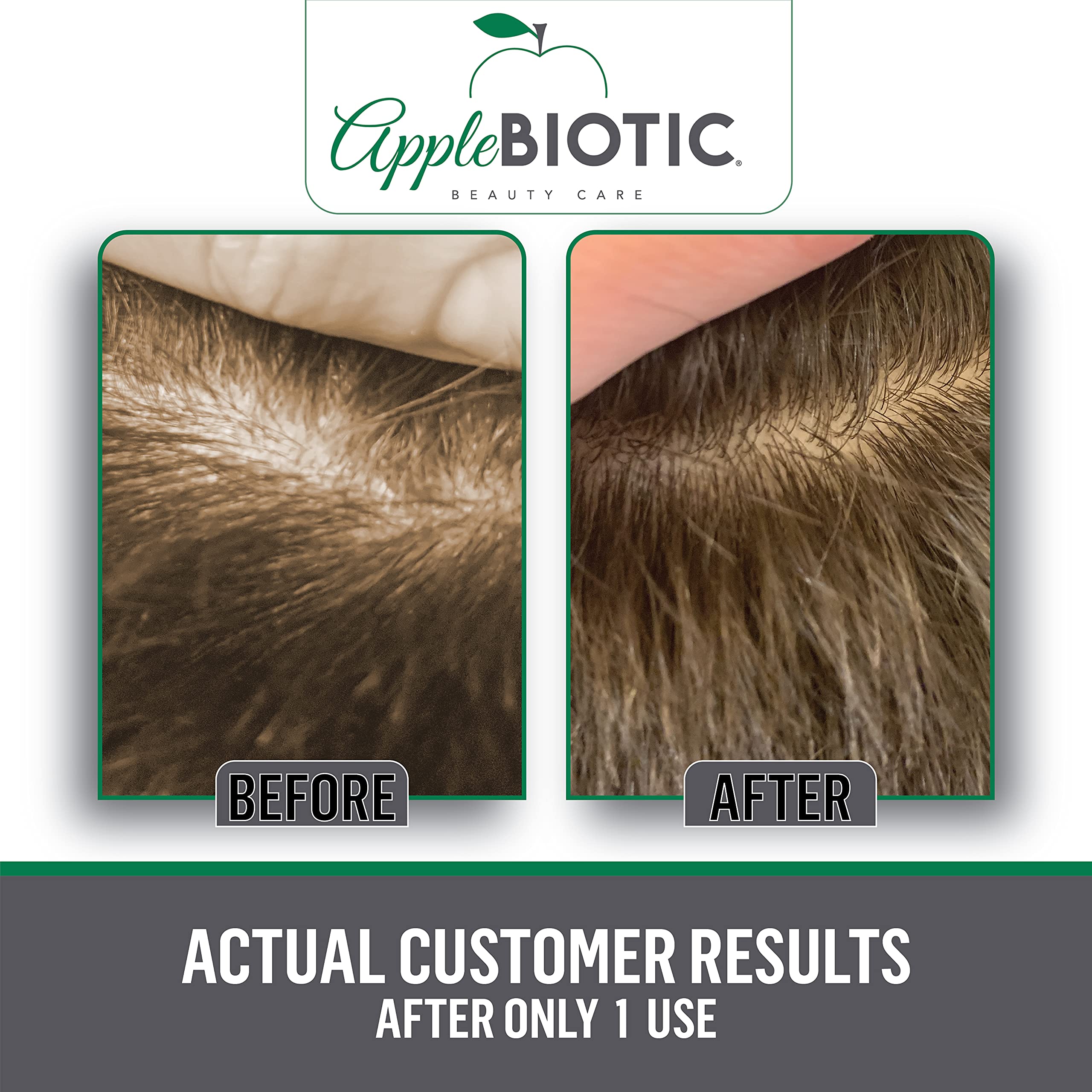 Apple Cider Vinegar Scalp Scrub Exfoliating Scalp Treatment with