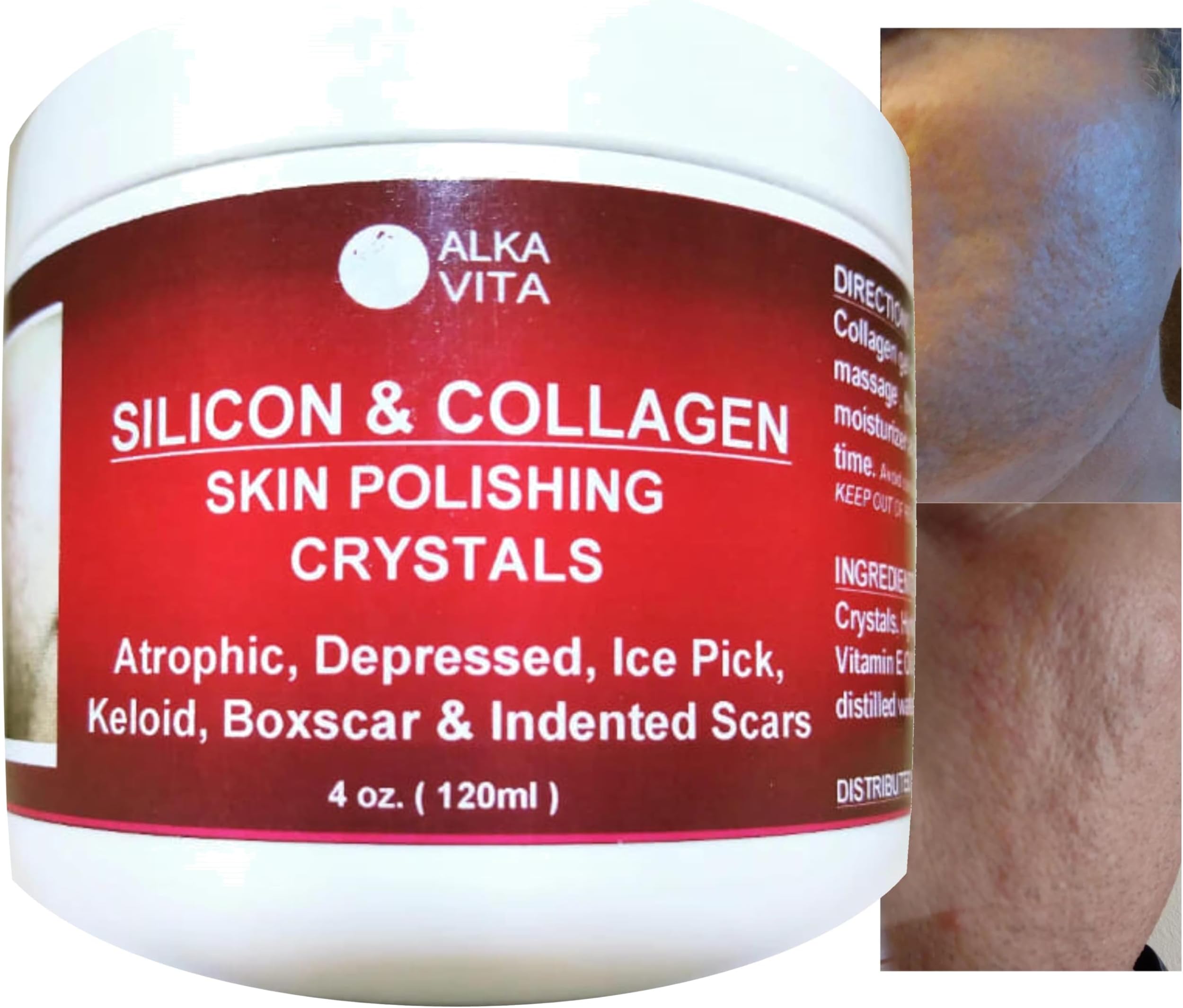 Acne Scars Silicon & Collagen Skin Polishing Crystals Gel For Indented Rolling Atrophic & Keloid Scars Natural Ingredients