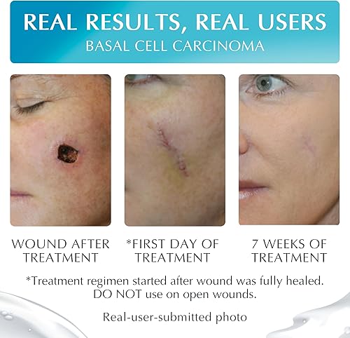 Miniatura 3 de NewGel+ Advanced gel de silicona para cicatrices