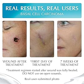 NewGel Plus Scar Gel by MyNewGel Advanced Professional Silicone Treatment for Old and New Scars w Vitamin E, High-Potency for Surgery, Keloids, Burns, and Facial Blemish Scars (30 Grams) - 1 oz