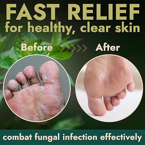 Miniatura 4 de Spray antifúngico para pies  Aerosol para pies de atletas, aerosol para olores de pies, tratamiento de tiña  Spray antipicazón para hongos en los