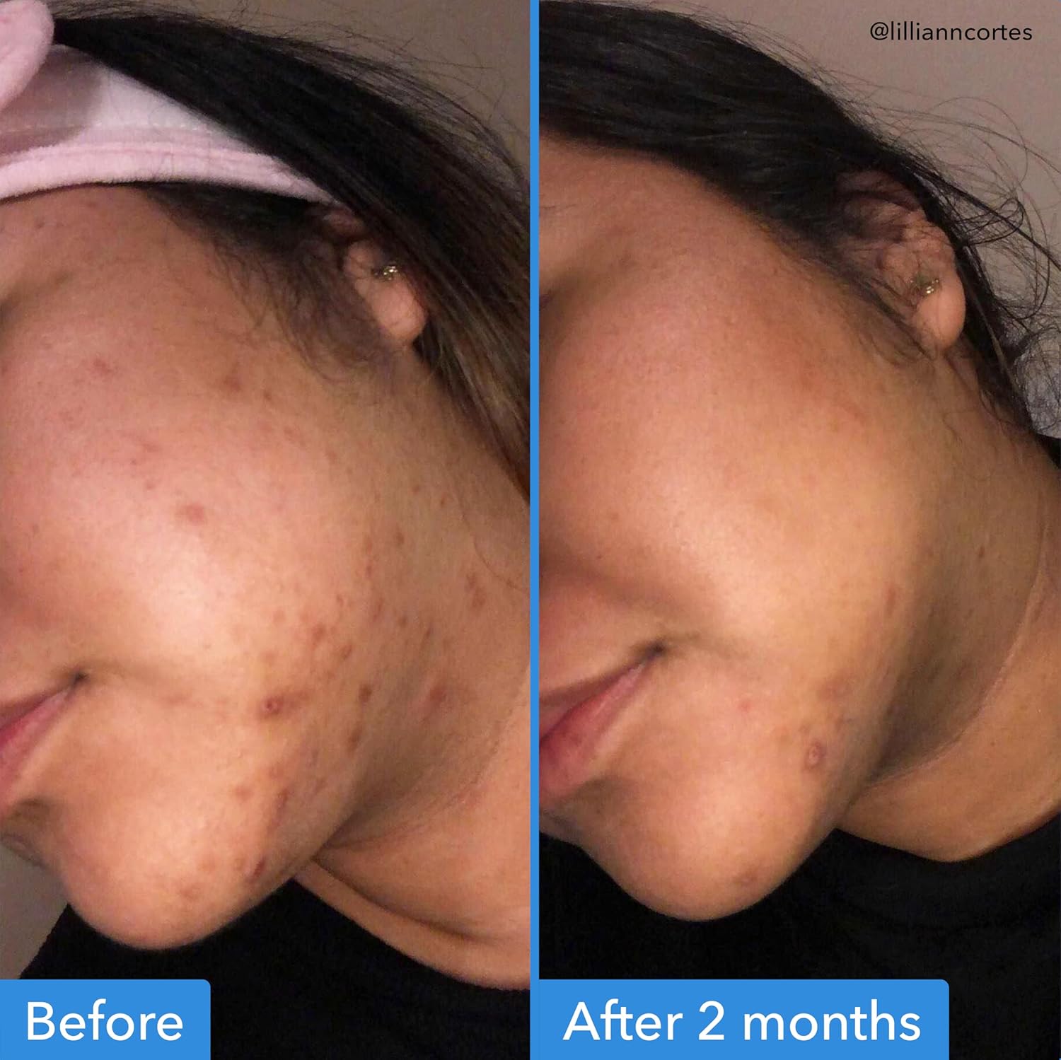 Good Molecules Discoloration Correcting Serum - Tranexamic Acid and Niacinamide Serum to Target Dark Spots and Hyperpigmentation - Skin Care for Face - Image 3