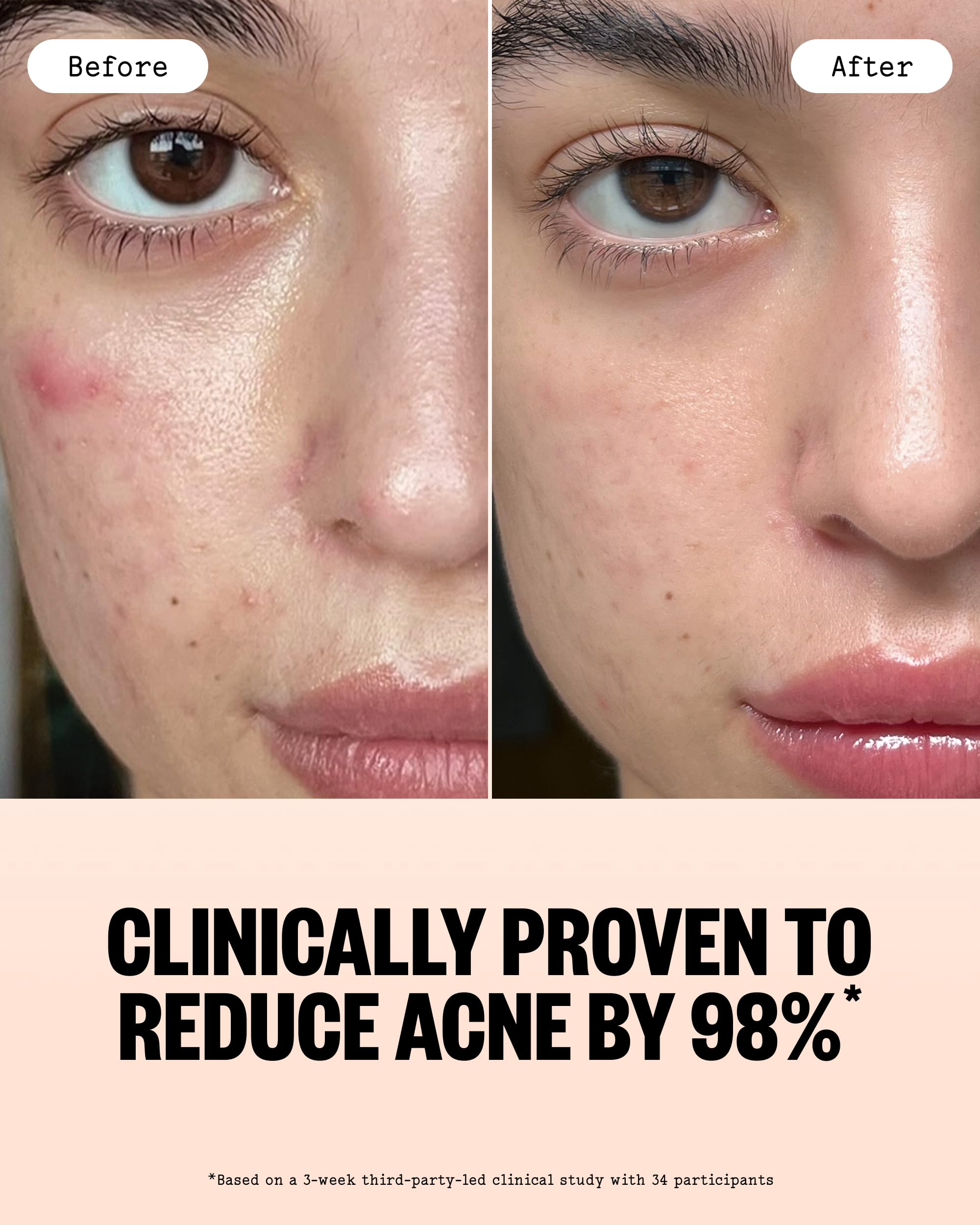 PEACE OUT Acne Gel Face Moisturizer with Salicylic Acid & Ceramides
