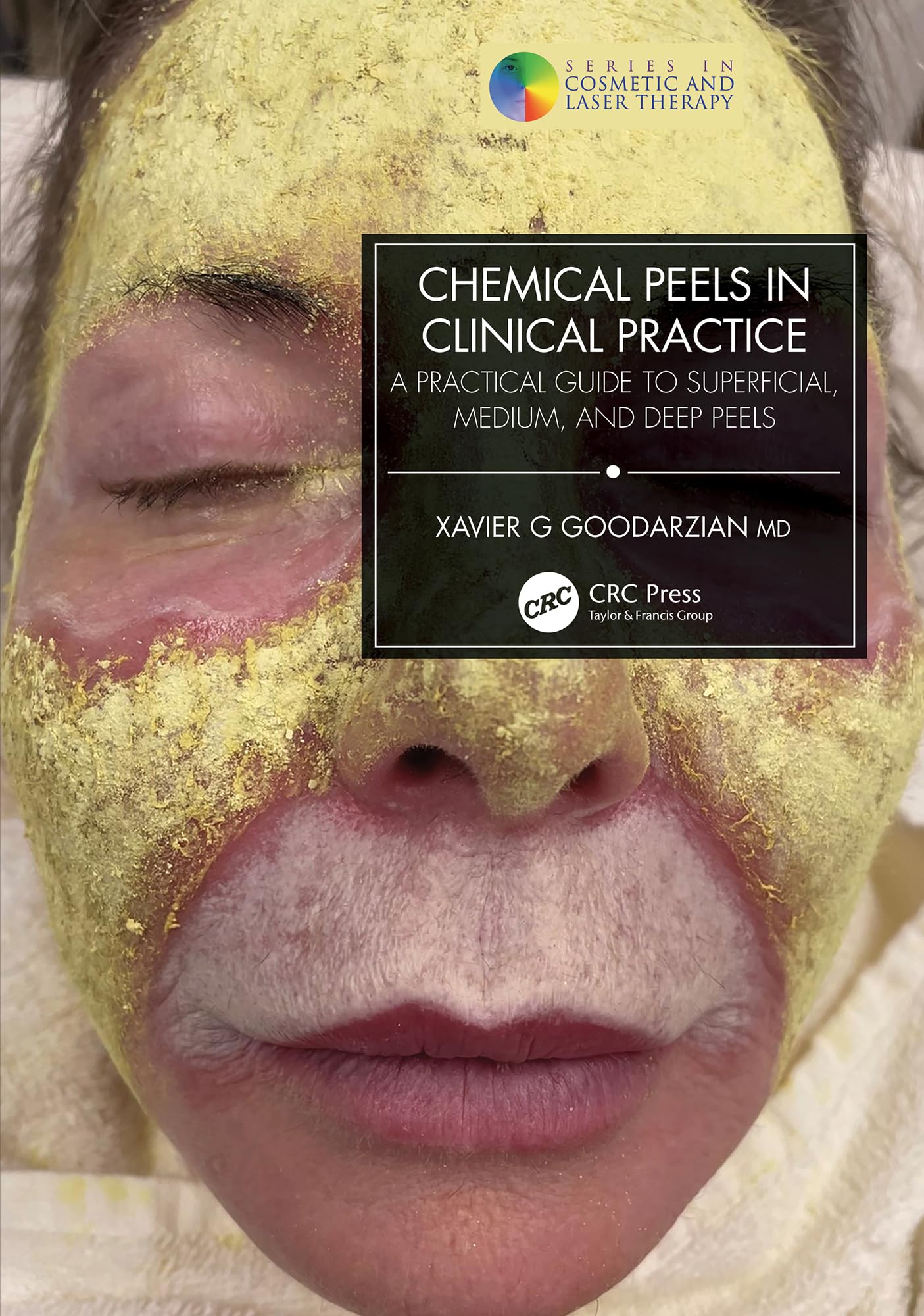 Chemical Peels in Clinical Practice: A Practical Guide to Superficial, Medium, and Deep Peels (Series in Cosmetic and Laser Therapy) (English Edition)