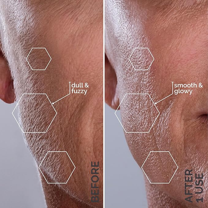 Dermaplaning is a popular exfoliation technique that involves using a blade to gently scrape off dead skin cells and peach fuzz. This process not only reveals smoother and brighter skin but also allows for better absorption of skincare products. The Sonicsmooth tool takes dermaplaning to the next level by incorporating sonic vibrations, which help to enhance the effectiveness of the exfoliation process.