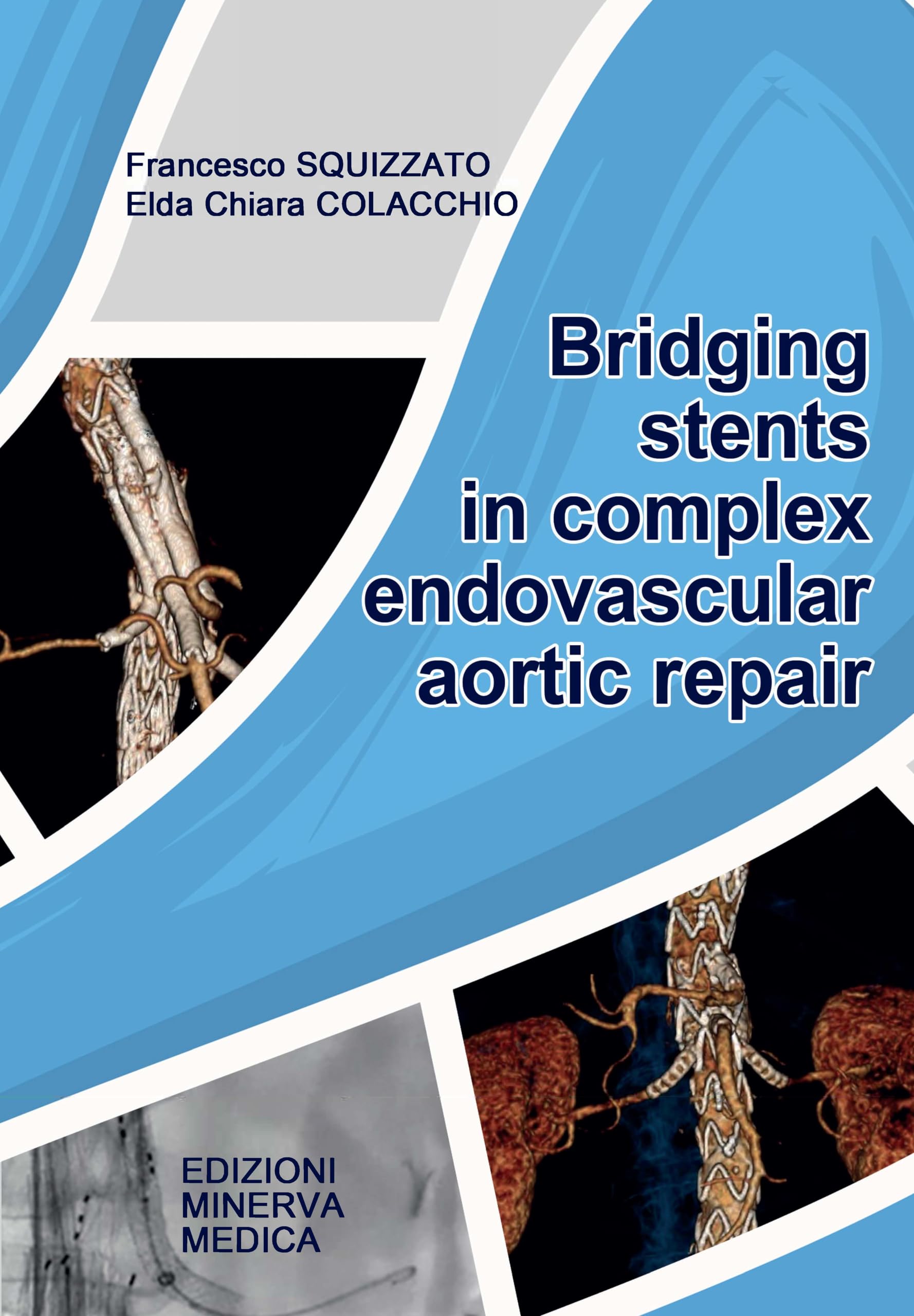 Bridging stents in complex endovascular aortic repair