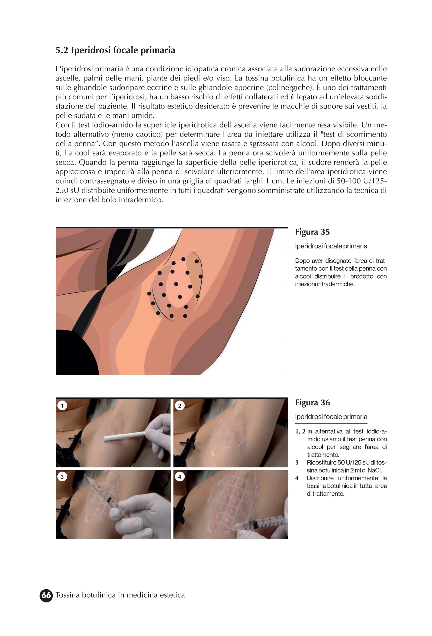 Tossina botulinica in medicina estetica. Protocolli iniettivi e gestione delle complicanze