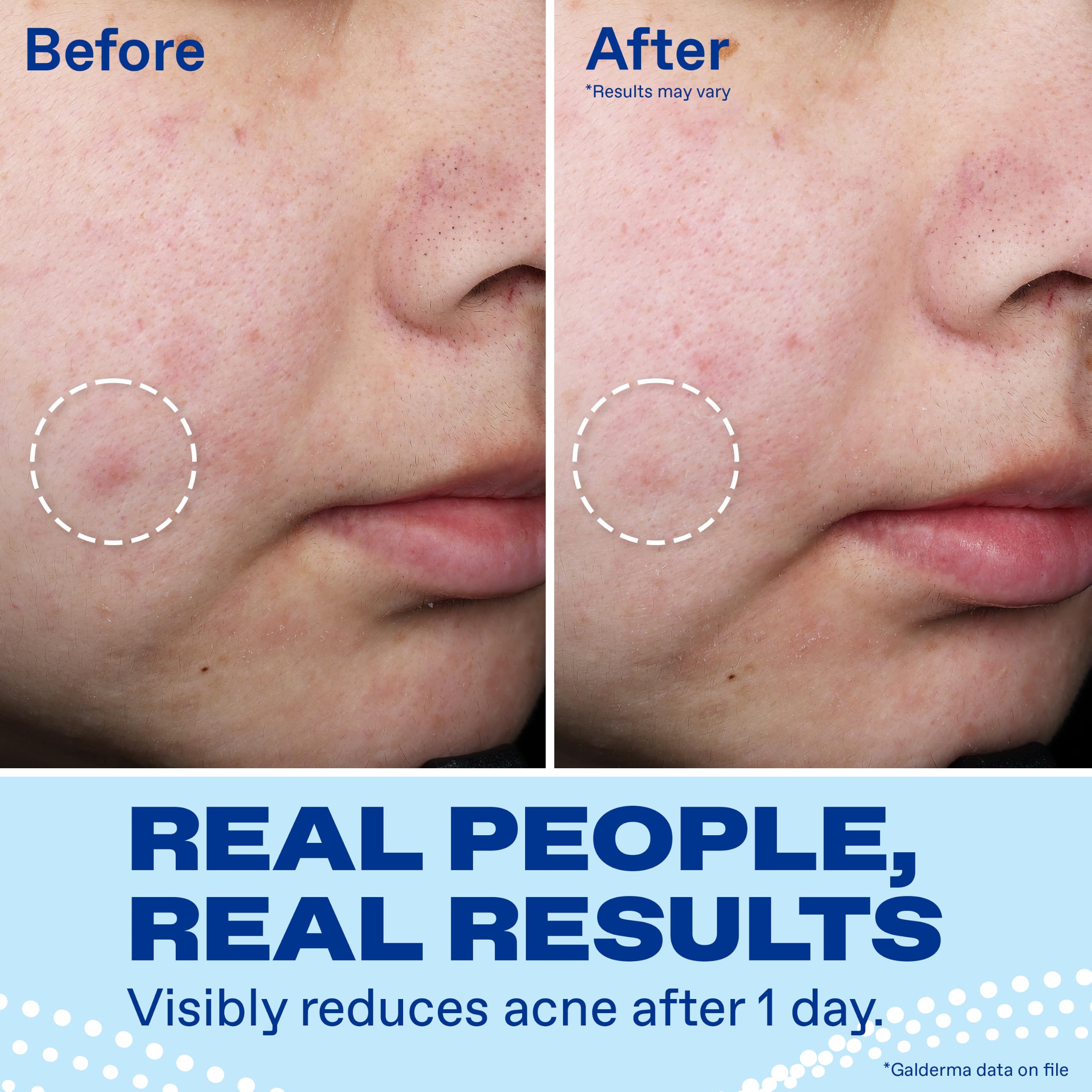 Differin Acne Spot Treatment - 10% Benzoyl Peroxide -5