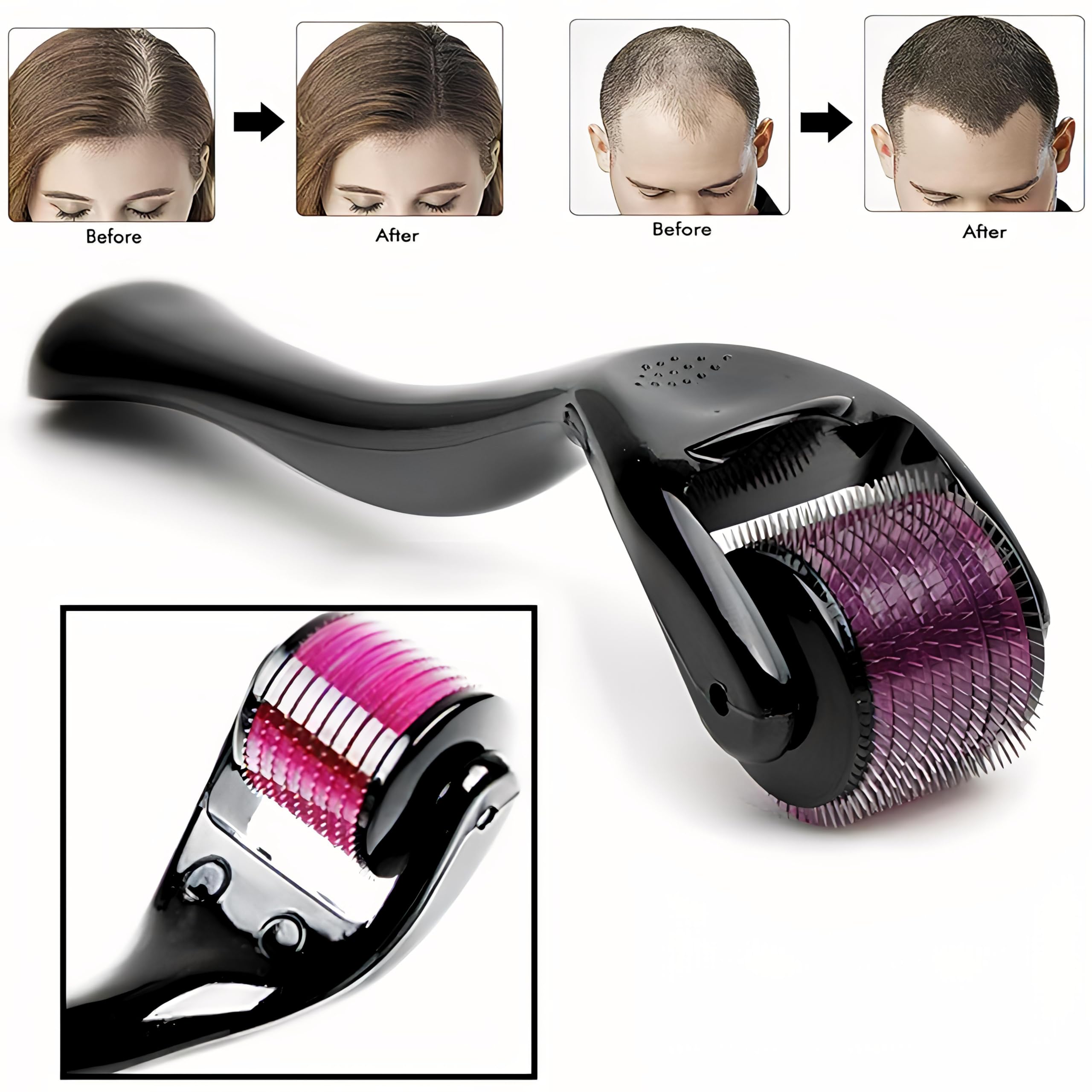 Derma Roller 540 Titanium Needles for Acne Scars Face Facial Wrinkles Hair Loss Stretch Marks Hair Operation Scars Regrowth Micro Needles Professional Micro needling Derma Needling (1.5mm) - Image 4