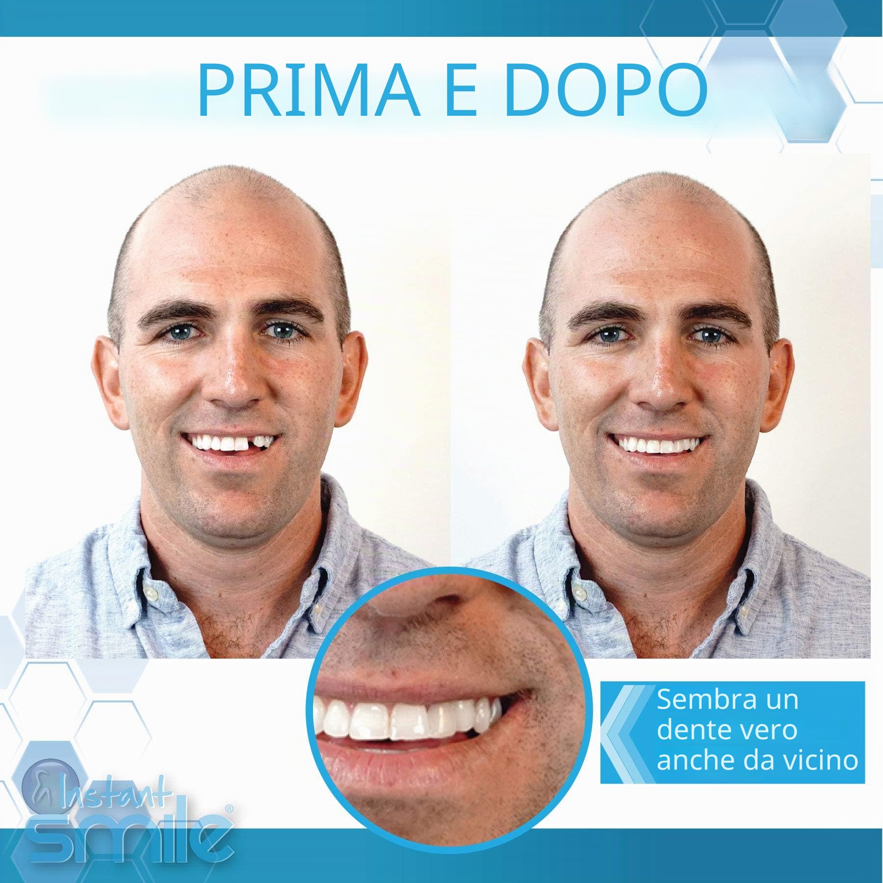 Instant Smile Completa il Tuo Sorriso Temporary Dental Replacement Kit, Easy Fit, One Size