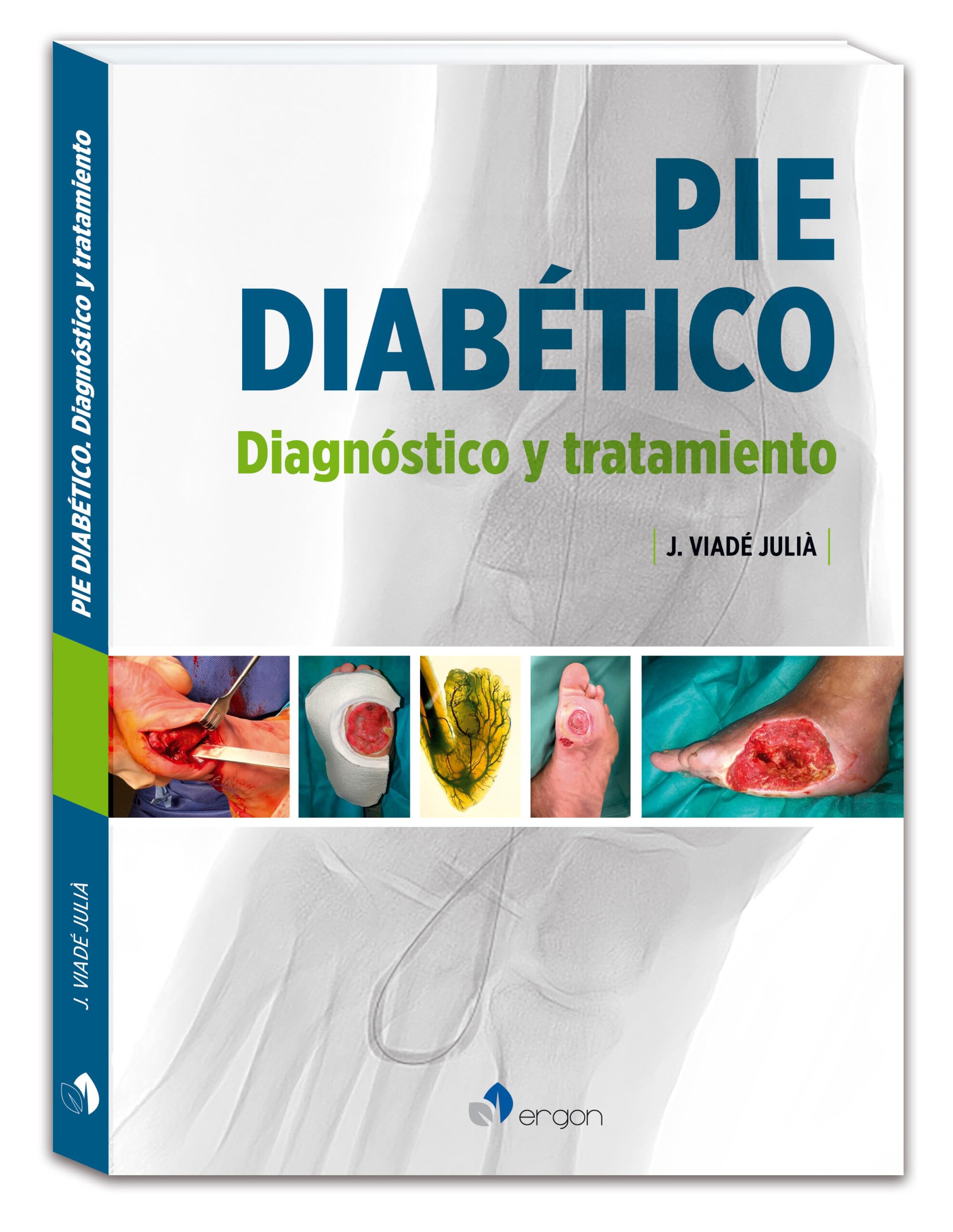 Pié diabético. Diagnóstico y tratamiento