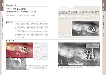 このシチュエーションにこの切開Flap Design Album | 岡村知彦・富塚