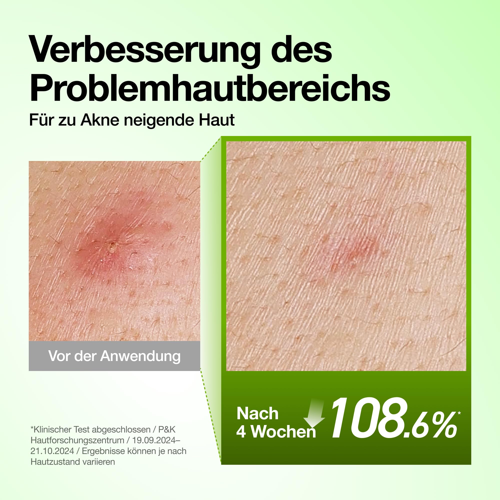 Anua Azelaic Acid 10 Hyaluron Redness Soothing Serum, Gesichtsserum für unreine & empfindliche Haut, Leichte & hydratisierende Hautpflege bei Unreinheiten, Hyaluronserum, Korean Skincare, 30ml