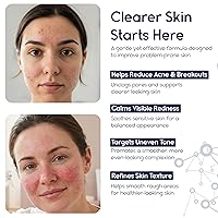 Vista 2 de Crema para el acné de ácido azelaico 15 para la cara, alivio del enrojecimiento, tratamiento de rosácea para la cara, alivia el acné