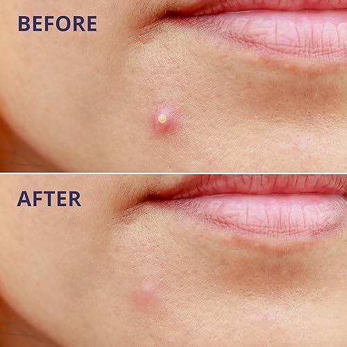 Miniatura 5 de Parches de espinillas para la cara (96 unidades). Parche invisible para acné hidrocoloide para manchas, zits y brotes. Cubierta fácil de usar para