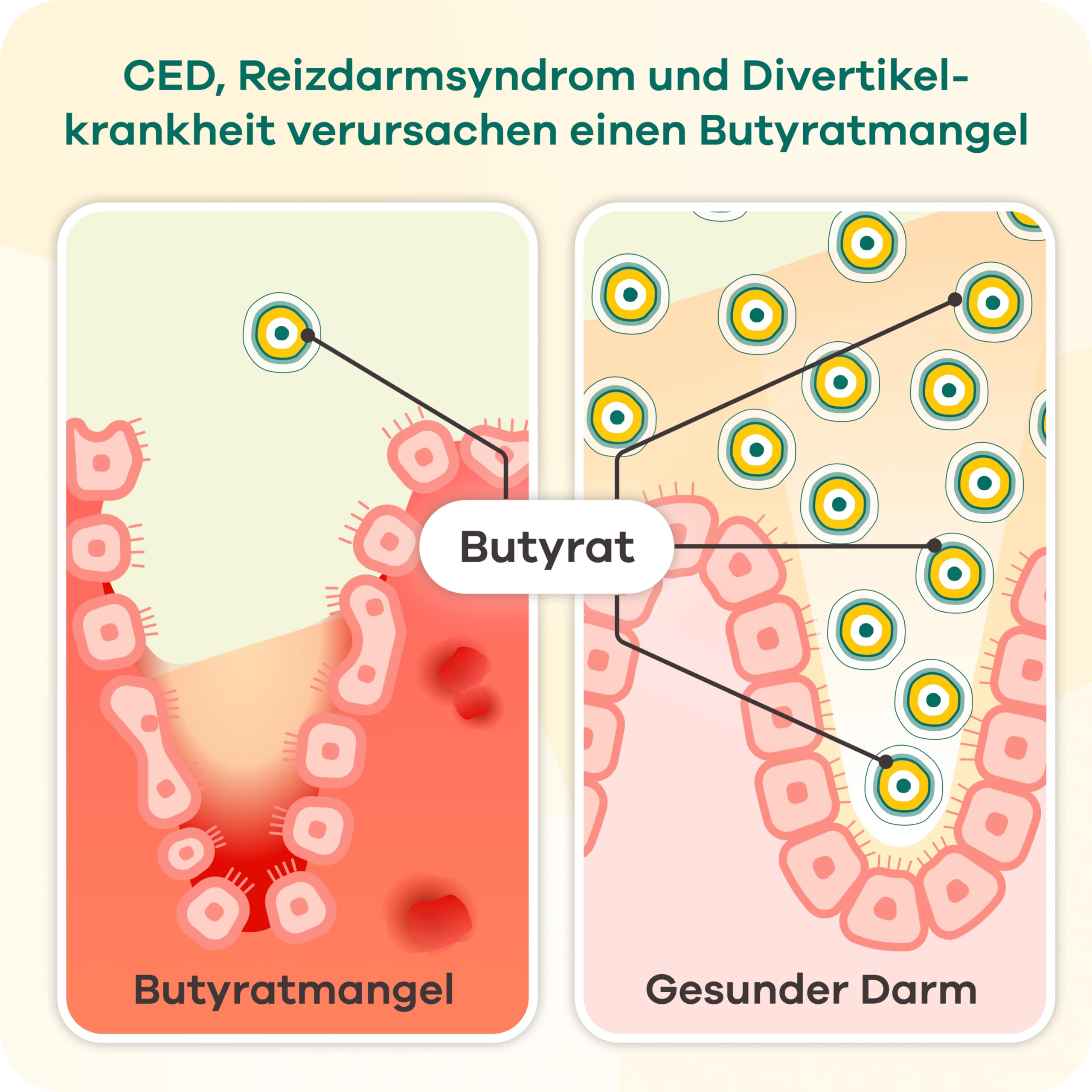 Butyzol Mikroverkapseltes Natriumbutyrat 60 Kapseln – Bei Reizdarmsyndrom, Divertikelkrankheit, Morbus Crohn, Colitis ulcerosa – Patentiert & Wirksamkeit durch Studien belegt