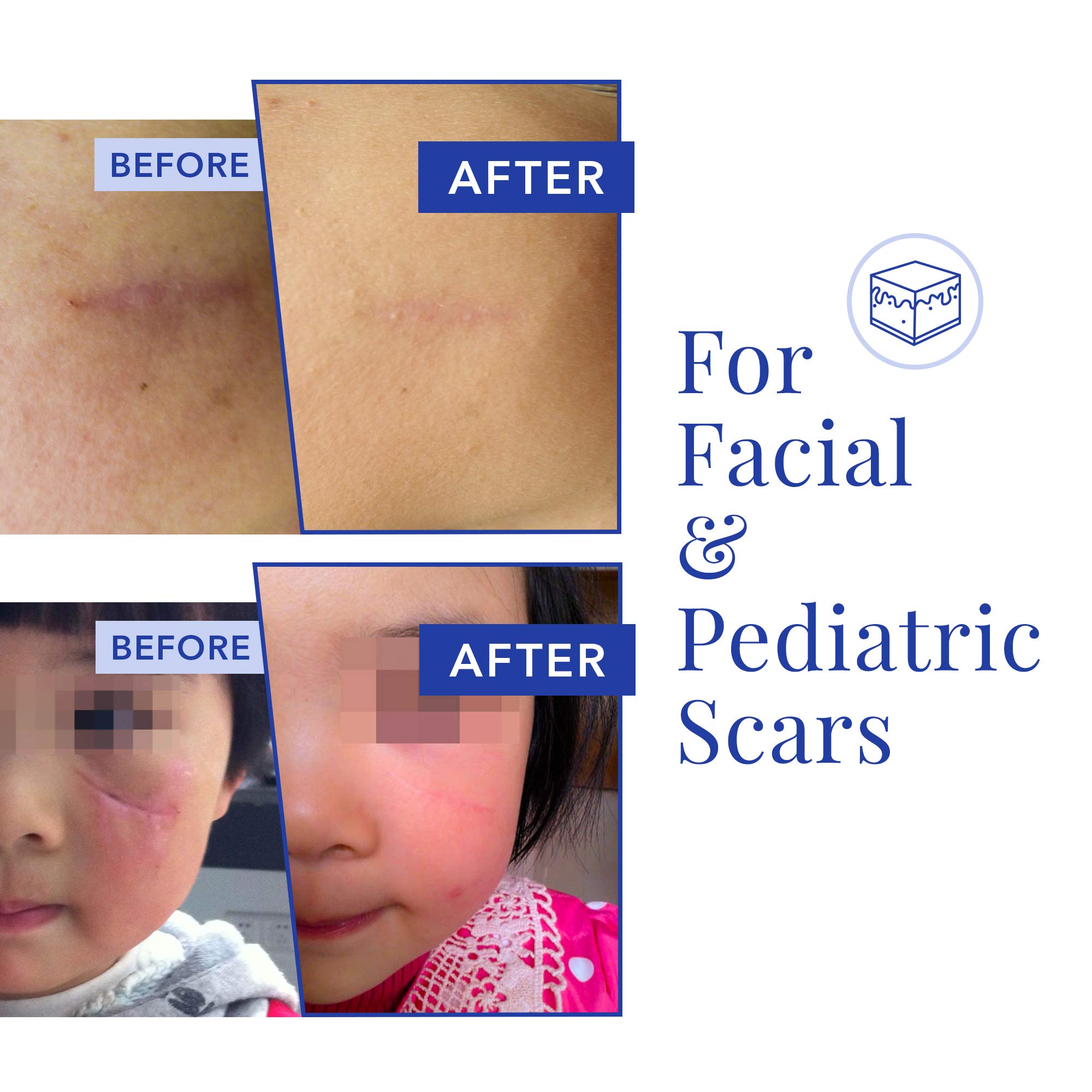 Buy RejuvaSil Silicone Scar Gel, Silicone Gel Treatment for Surgical