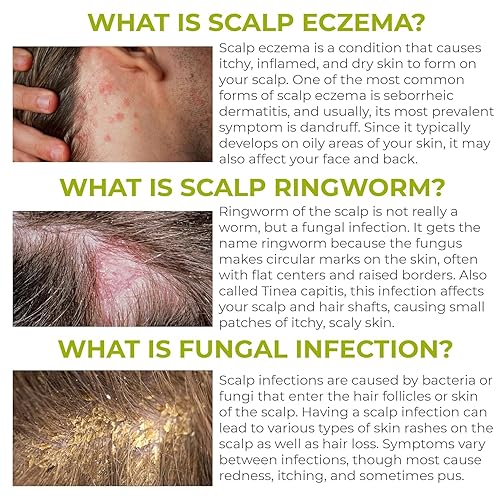 Miniatura 3 de Champú para foliculitis  Champú antifúngico para dermatitis seborreica, psoriasis del cuero cabelludo y caspa  Alivia la picazón y el cuero