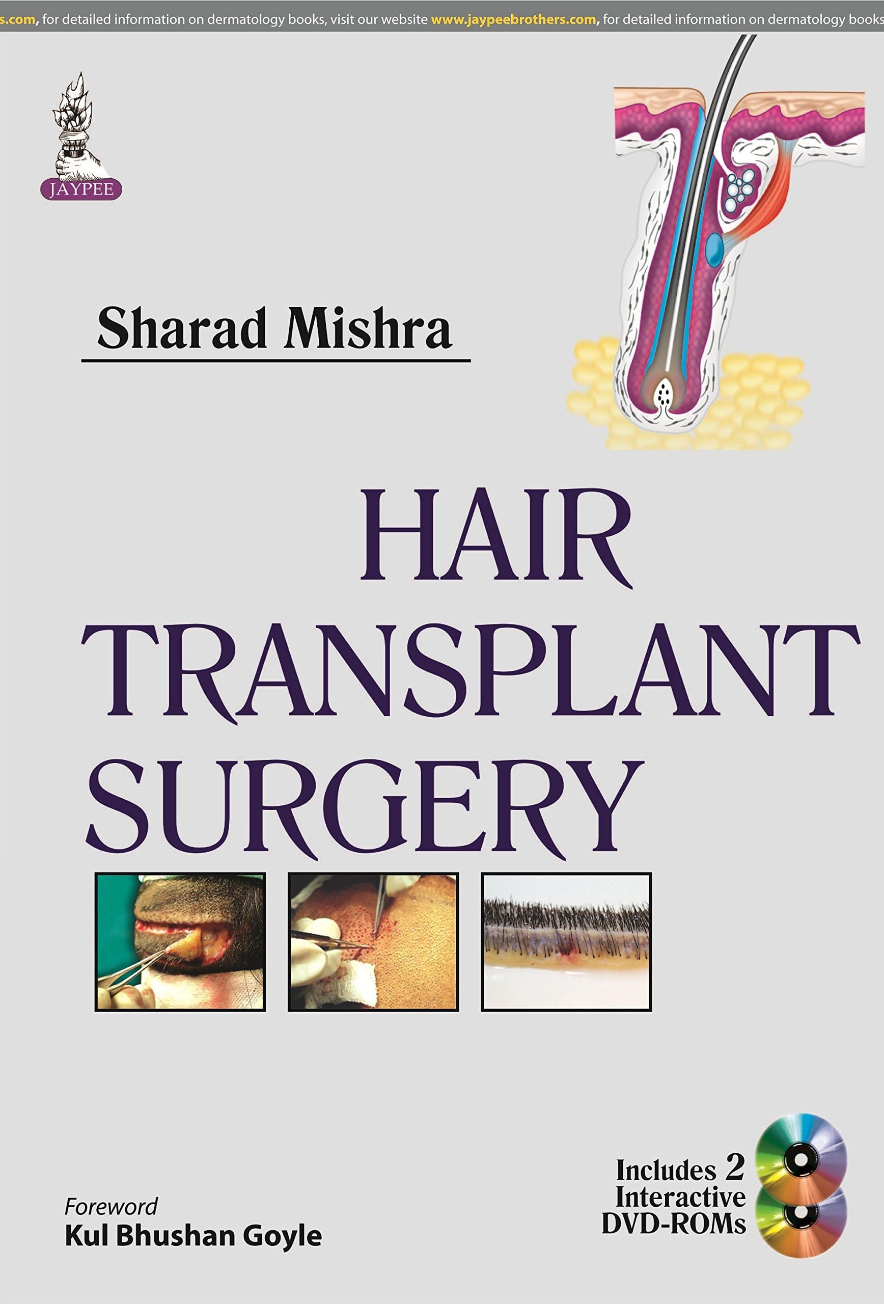 Hair Transplant Surgery Hardcover – 31 Oct. 2014