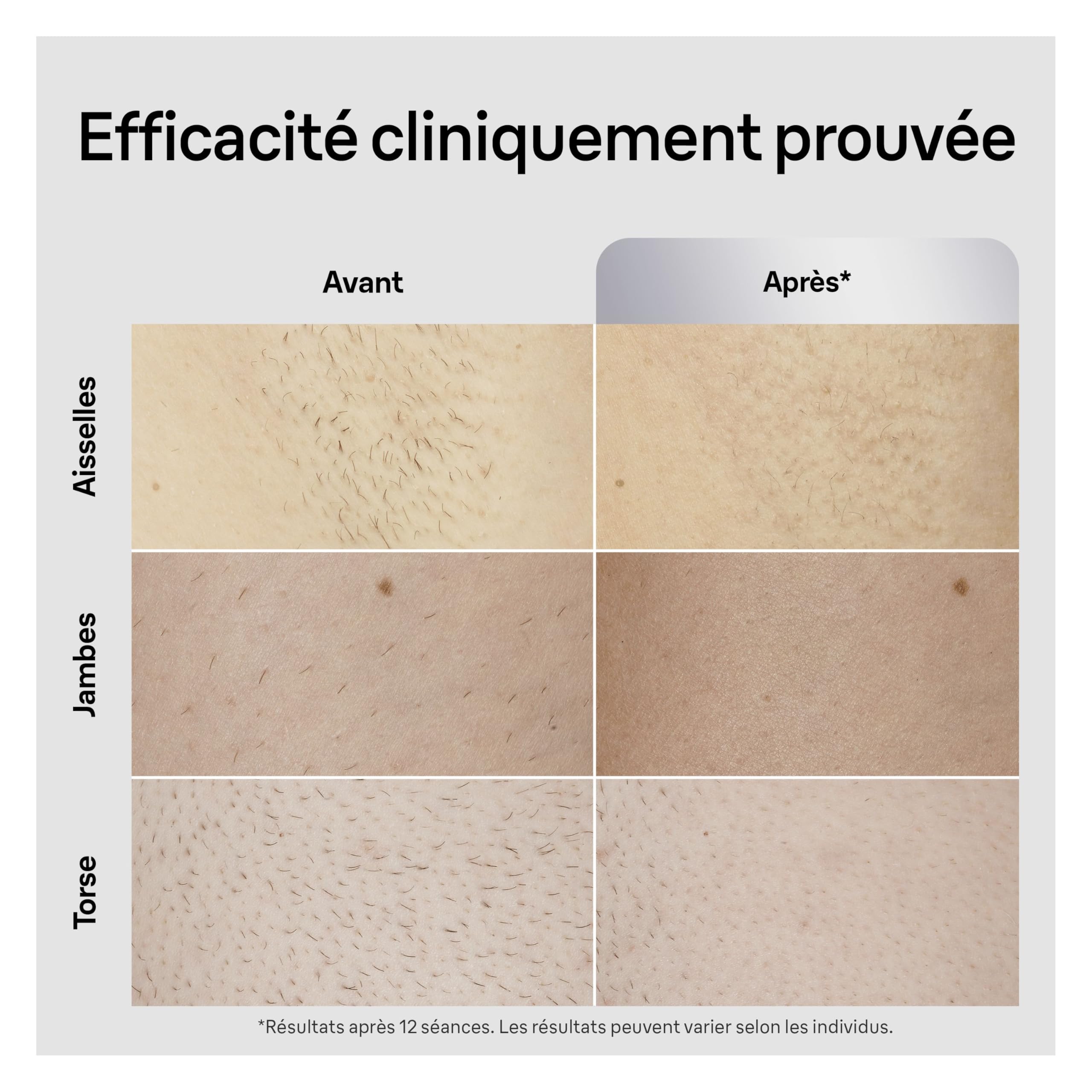 Braun Epilateur Lumiere Pulsee Silk·expert Pro 5, Epilation Semi-Définitive, Alternative Au Laser, Résultats En 2 Séances, Têtes Pour Épiler Jambes, Visage, Maillot Et Plus