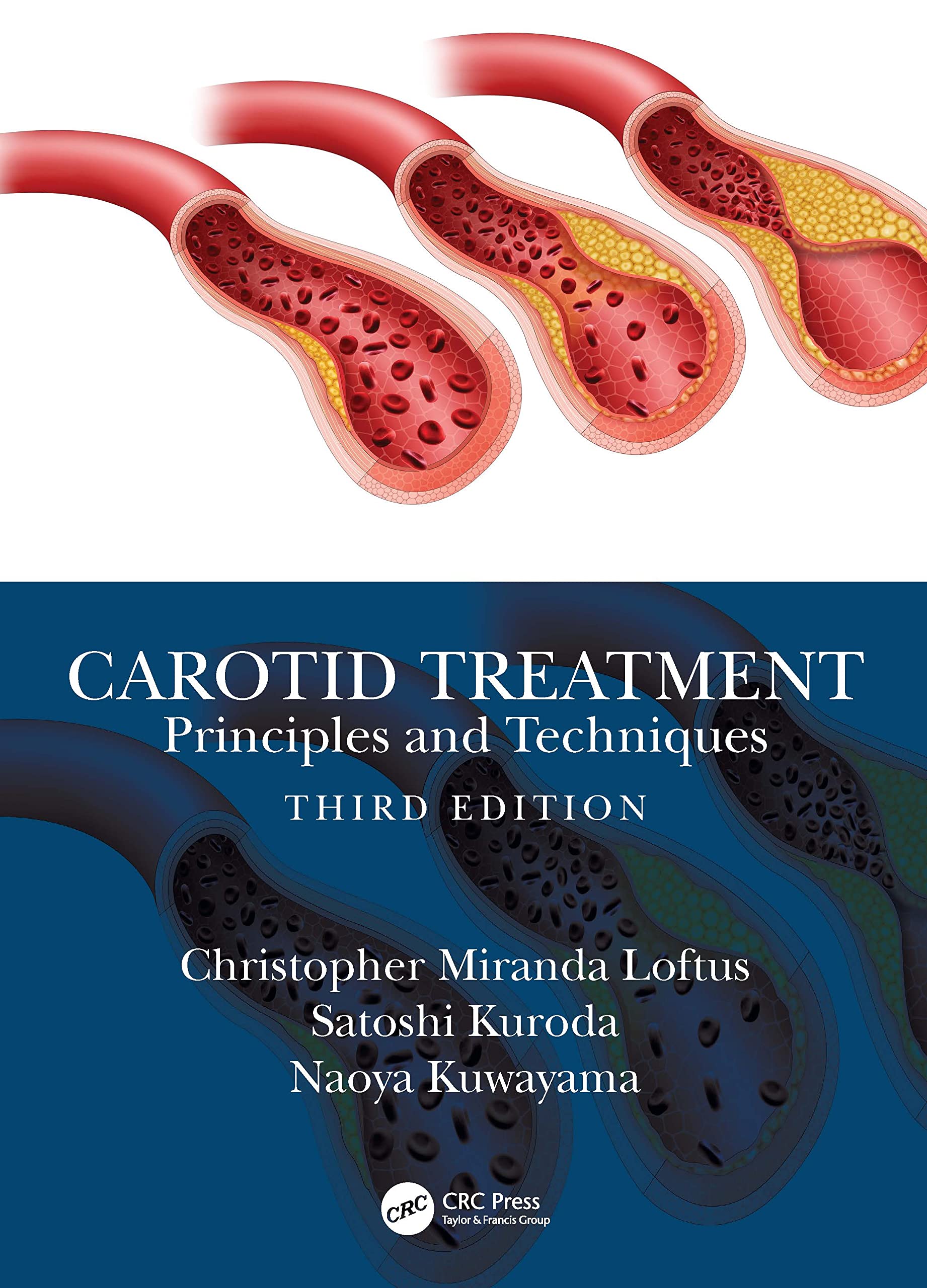 Practical Carotid Artery Stenting [ハードカバー] Practical Carotid Artery Stenting [ハードカバー]