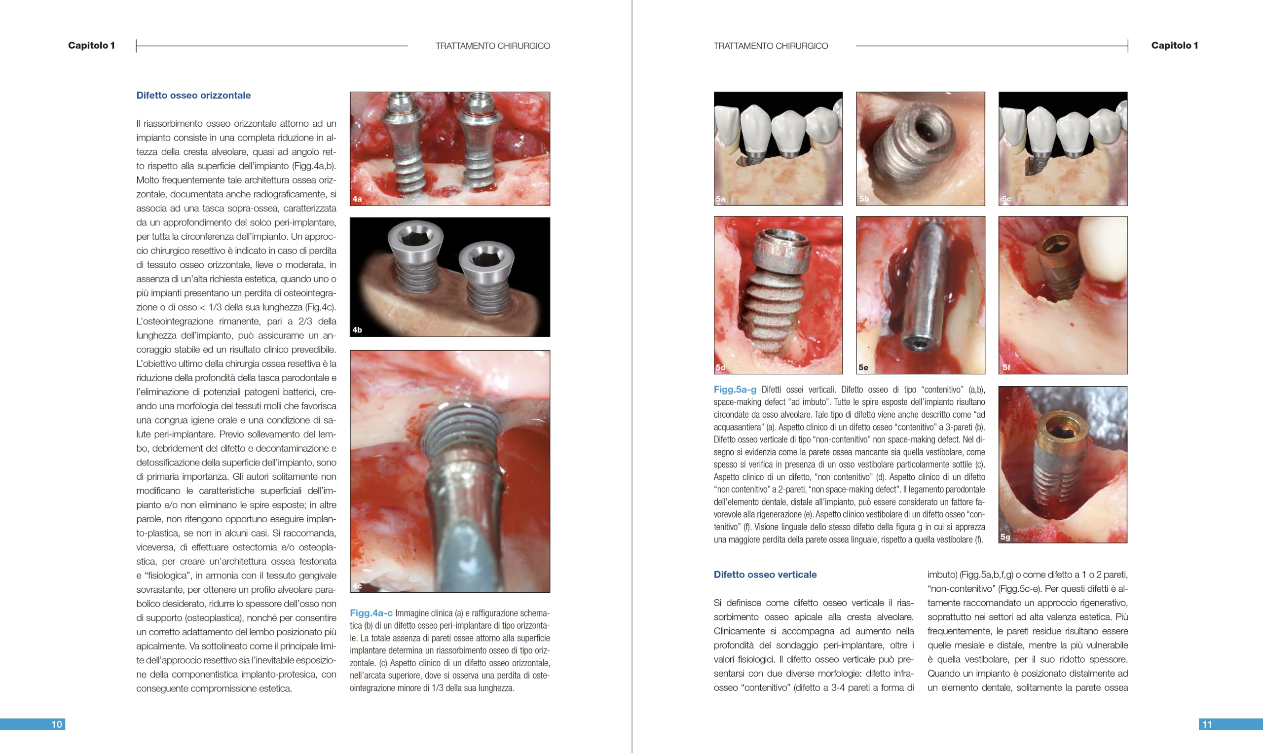 Malattie peri-implantari. Trattamenti chirurgici