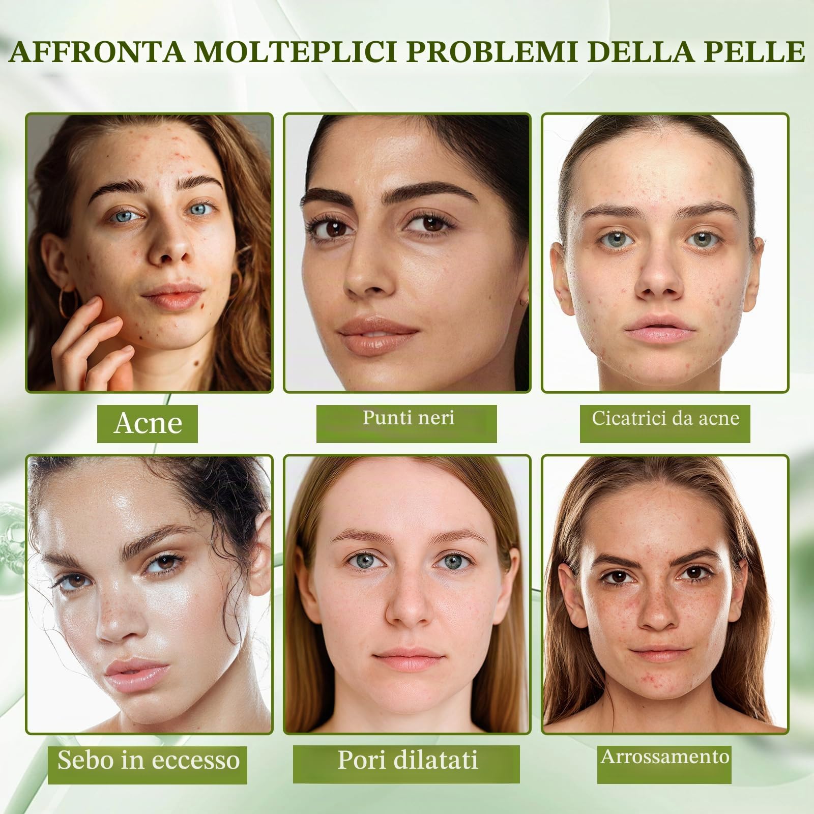 Crema Brufoli Viso, Crema Acne Potentissima, Combatte Efficacemente Acne, Brufoli e Punti Neri, Lenisce Rapidamente Gli Arrossamenti Cutanei, Adatto a Tutti i Tipi di Pelle, Ingredienti Delicati