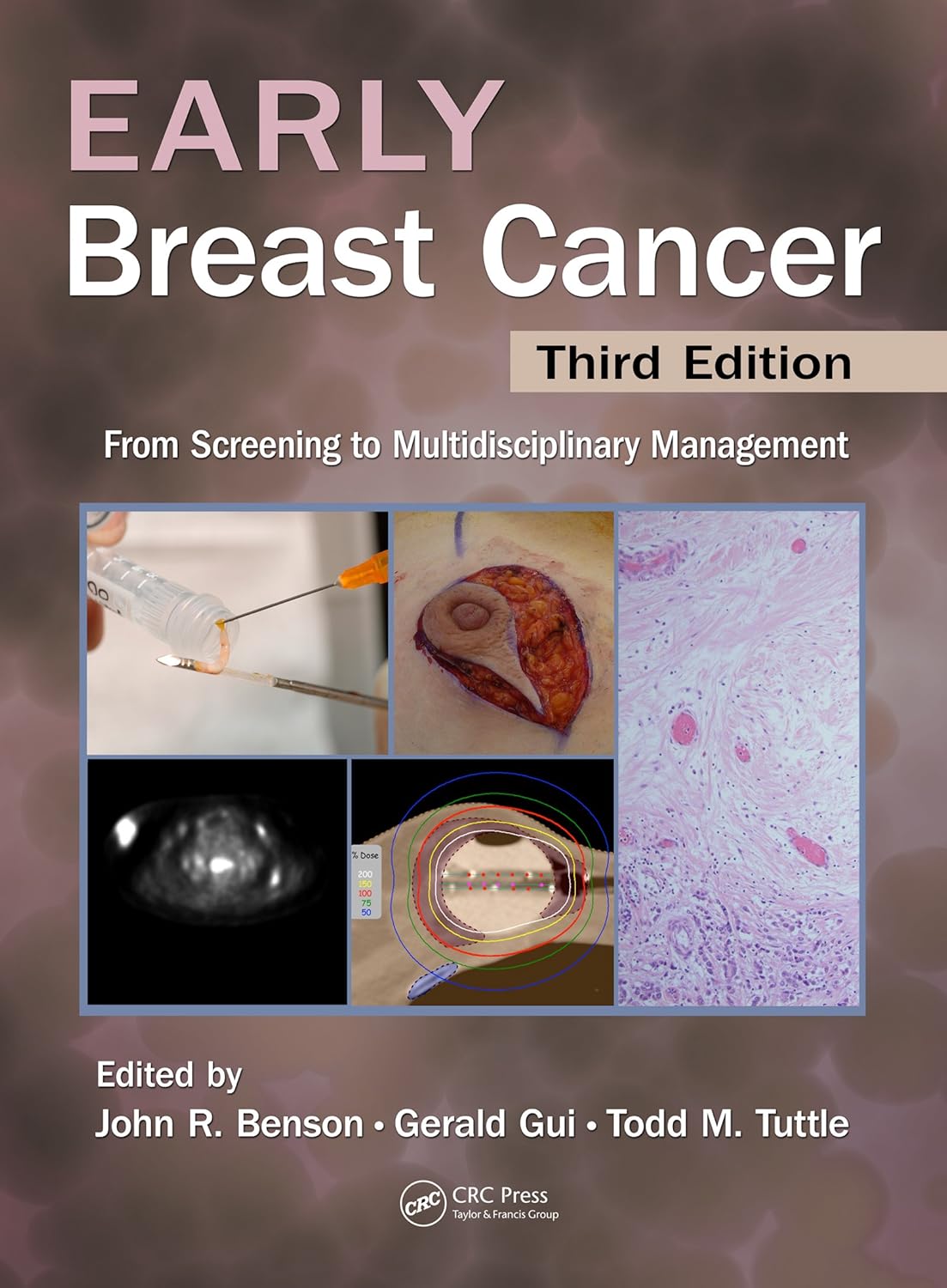 Early Breast Cancer: From Screening to Multidisciplinary Management, Third Edition      3rd Edition, Kindle Edition