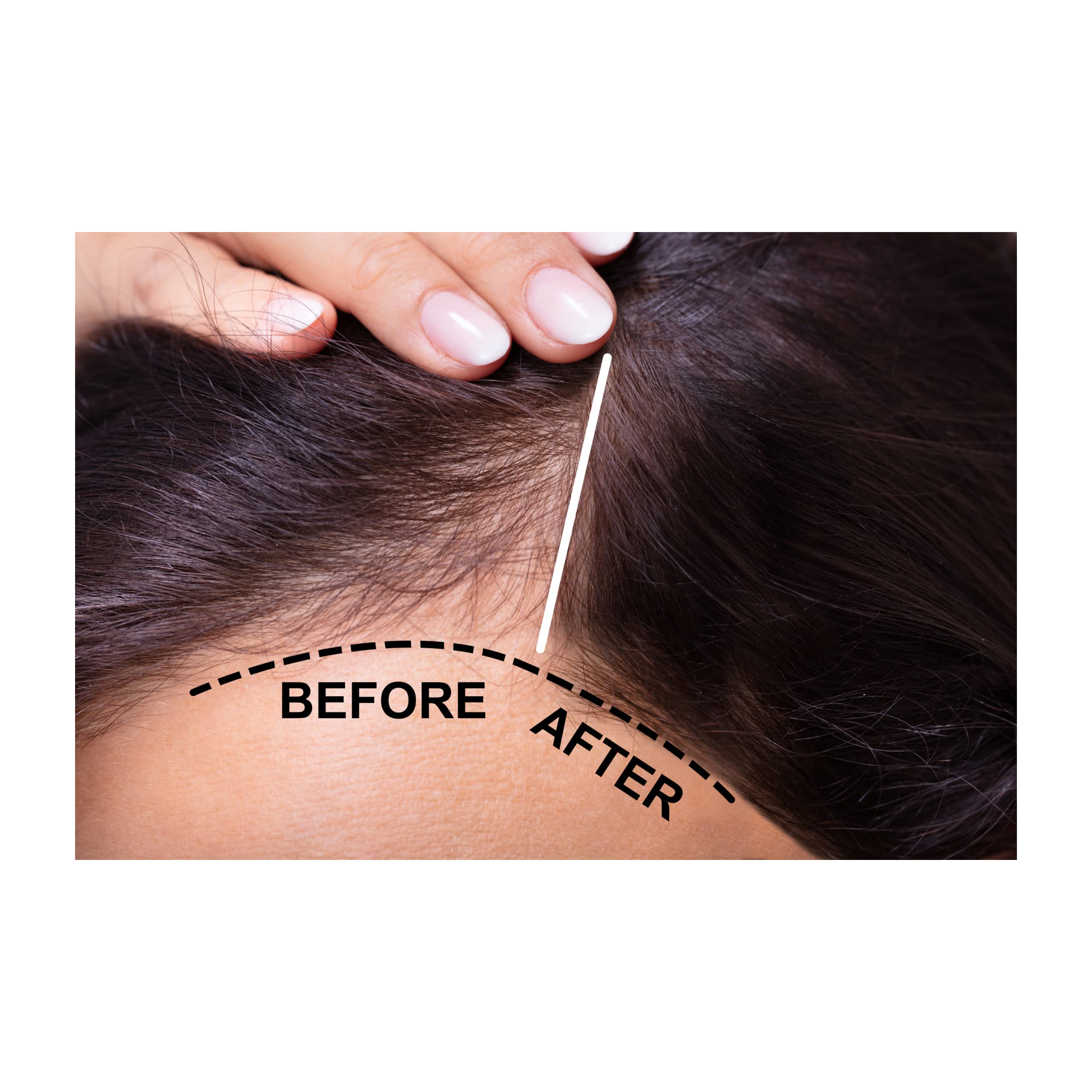 Shahnaz Husain Shatone Plus Herbal Scalp Tonic - 200ml IMPROVED FORMULA /