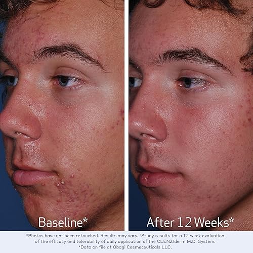 Miniatura 4 de Obagi Medical CLENZIderm MD Pore Therapy Acne Treatment