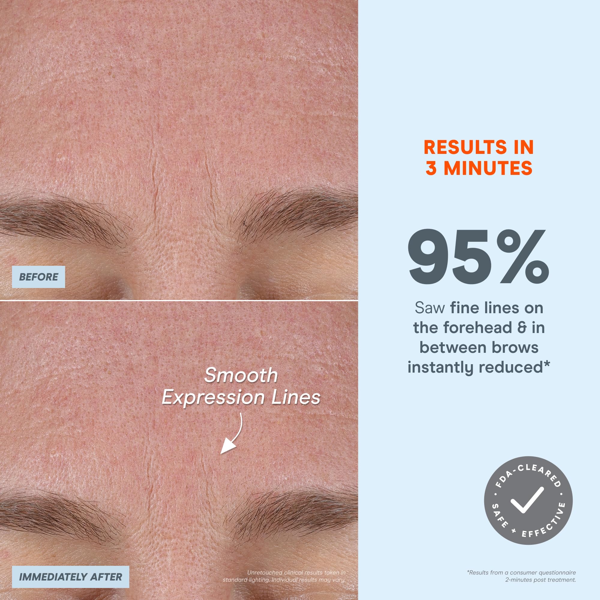 NuFACE FIX MicroWand - Microcurrent Device + Serum Activator for On-The-Go Treatment of Forehead Lines, Crow's Feet, Under Eyes, Smile Lines & Fuller-Looking Lips