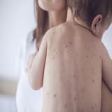 Symptoms Of Measles