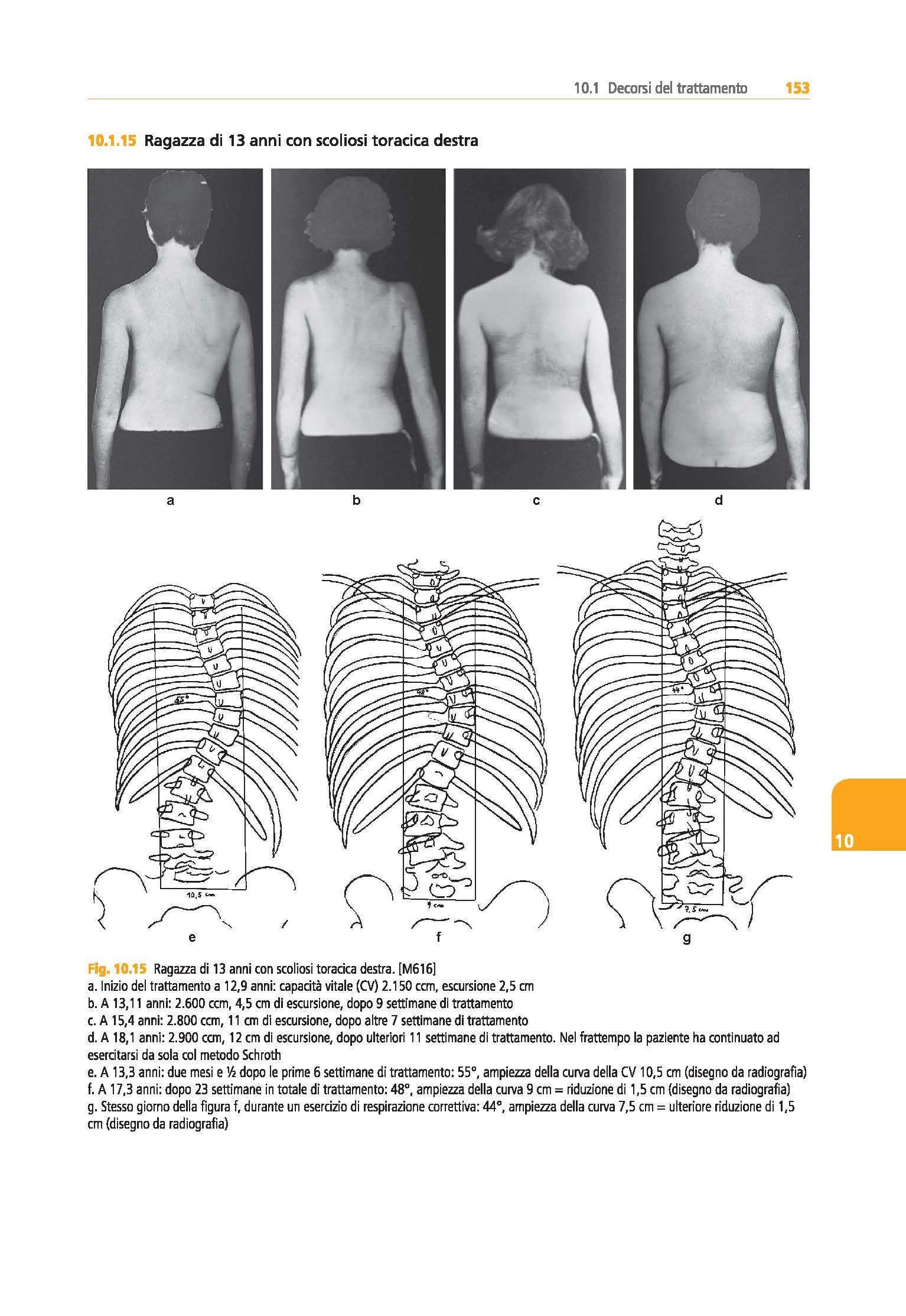 Trattamento tridimensionale della scoliosi. Ortopedia respiratoria. Metodo Schroth