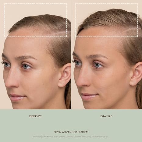 VEGAMOUR GRO+ Advanced Balancing Shampoo and Conditioner Kit | Removes Buildup, Hydrates the Scalp and Softens Strands | For Severe Signs of Thinning | Color Safe, Vegan, Cruelty-Free (8 Fl Oz each)